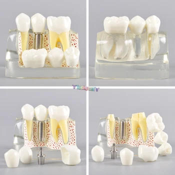 1gab Zobu Mācīt Implantu Analīze Vainagu Tilta Noņemams Modelis Zobu Demonstrēšanas Zobu Modelis