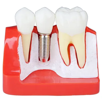 4 Reizes Zobu Modeli, Zobu Implantācija, Analīze Vainagu Tilta Demonstrācijas Zobu Zobu Modeli, Zobārsts Rīki Mācību Modelis
