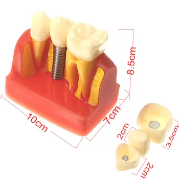4 Reizes Zobu Modeli, Zobu Implantācija, Analīze Vainagu Tilta Demonstrācijas Zobu Zobu Modeli, Zobārsts Rīki Mācību Modelis