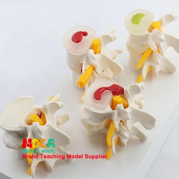 Cilvēka skelets Departamenta ortopēdijas mācību muguras modelis bojājumu jostas modelis medicīnas mācību MYZ005