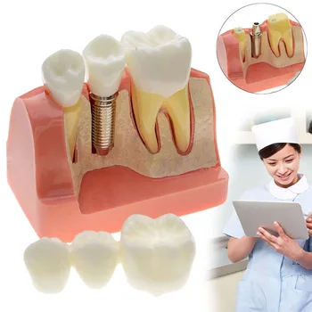 Profesionālā Zobu Zobu Modelis Pārredzamu Patoloģiskas Implantu Nervu Modeli, Zinātne, Medicīnas Zobu Slimības Mācību Pētījums