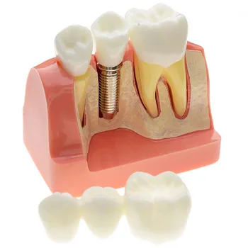 Profesionālā Zobu Zobu Modelis Pārredzamu Patoloģiskas Implantu Nervu Modeli, Zinātne, Medicīnas Zobu Slimības Mācību Pētījums