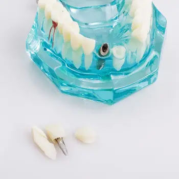 Zobārstniecības Studiju Zoba Modelis Pieaugušo Patoloģiskas mācību Zobu modeli, jaunu denshine